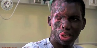 Christian Pastor Horrifically Scarred in Muslim Acid Attack Warns America Against Islam Christian Pastor Horrifically Scarred in Muslim Acid Attack Warns America Against Islam