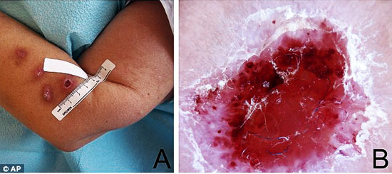 morgellons