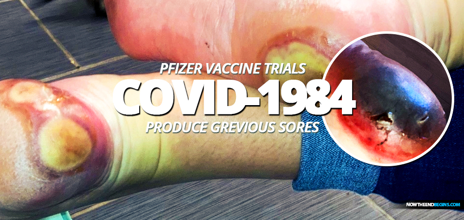 patricia-chandler-pfizer-bionmed-covid-1984-coronavirus-vaccine-trials-produces-grievous-sores-on-feet-fixed-drug-eruption
