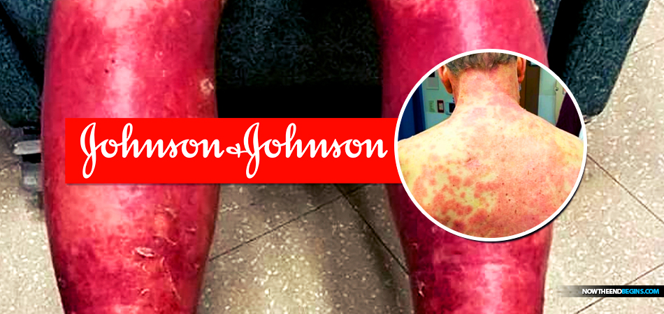 johnson-covid-vaccine-jab-adverse-reaction-virginia-mans-skin-peels-away-delayed-cutaneous-hypersensitivity-johnson